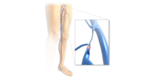 Endovenöse Lasertherapie